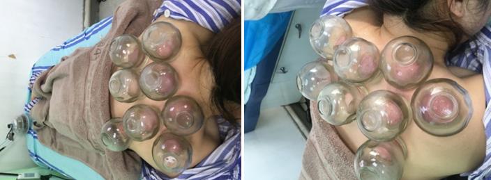 艾灸罐拔罐,火罐疗法和艾灸疗法的注意事项