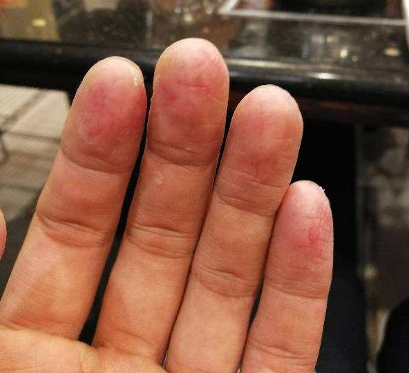 婴宝能治疗手蜕皮吗,小宝宝手蜕皮蜕的很严重怎么办