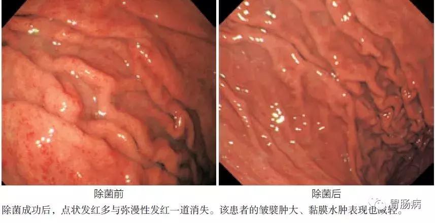 非浅表性萎缩胃炎会癌变吗,浅表性非萎缩胃炎用什么药