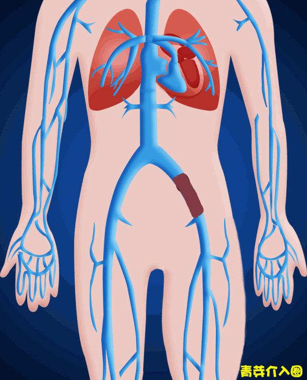 腿肿要警惕四种病,人的腿肿是什么病的前兆