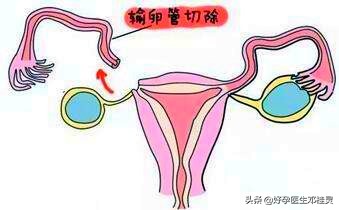 宫外孕和怀孕的症状都一样吗,宫外孕到底是什么感觉