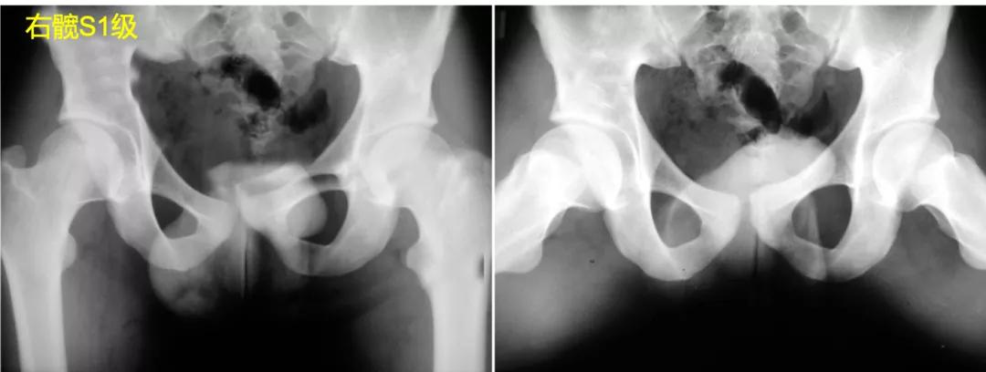 perthes可以治愈么,儿童股骨头坏死指南2020