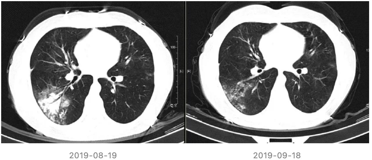 特发性肺炎一直用激素治疗,机化性肺炎住院治疗使用什么药物