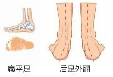 产后脚后跟疼的原因在这里，两个方法帮你改善
