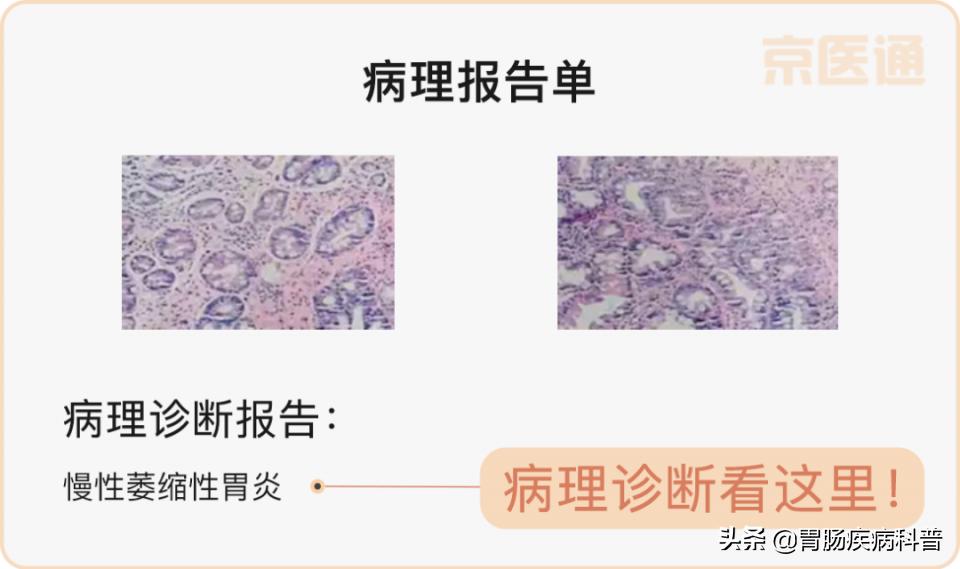 肠胃镜报告要等多久,教你3分钟看懂胃镜活检病理报告