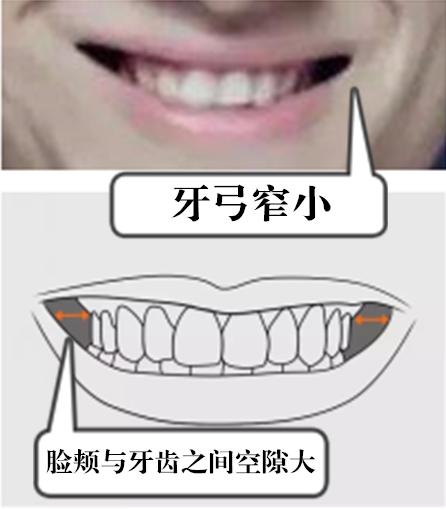 龅牙拥挤矫正需要拔牙吗,牙齿拥挤要拔智齿吗