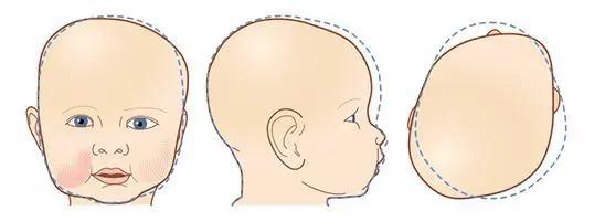 小孩头睡歪了用什么方法调整,婴儿头往右边歪应该朝哪边睡