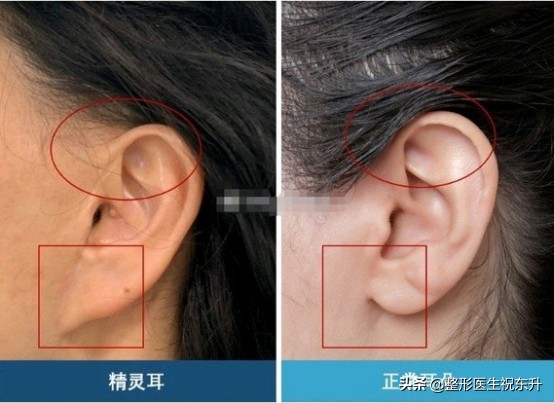 面部提升手术和拉皮手术是一样吗,面部小拉皮手术提升效果和视频