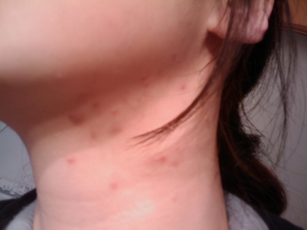 脖子腋下腹股沟长小肉粒怎么去除,腋下脖子上长小肉粒是什么原因