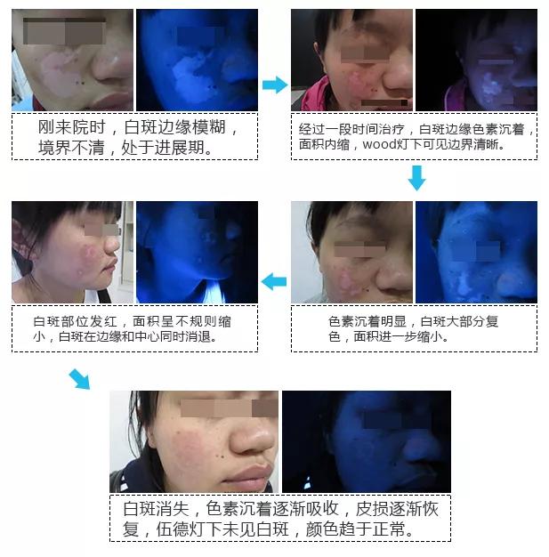 308光疗治疗白癜风副作用,308白癜风光疗后掉皮正常吗