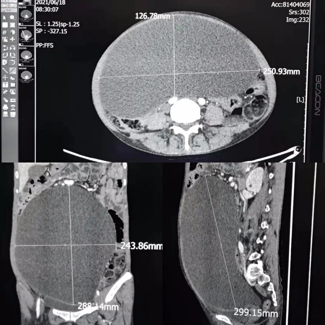 丨传承·创新丨短期内腹部增大要警惕！未必是胖，可能是病——单孔腔镜开启外科微创手术的“无痕”时代