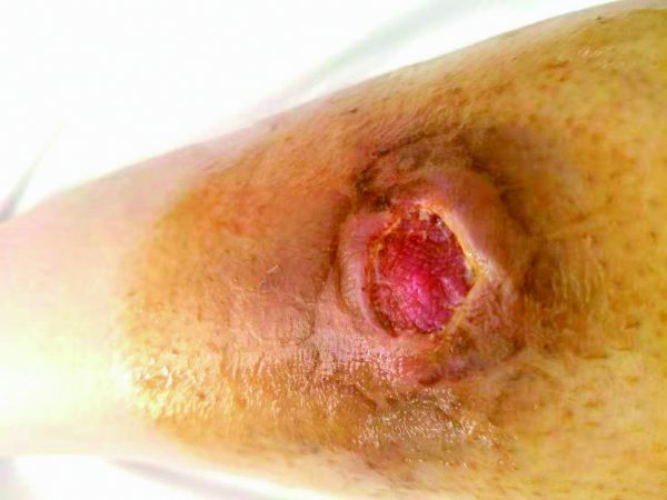 女子埋线减肥后遗症,女子埋40根线减肥20处脓肿险丧命