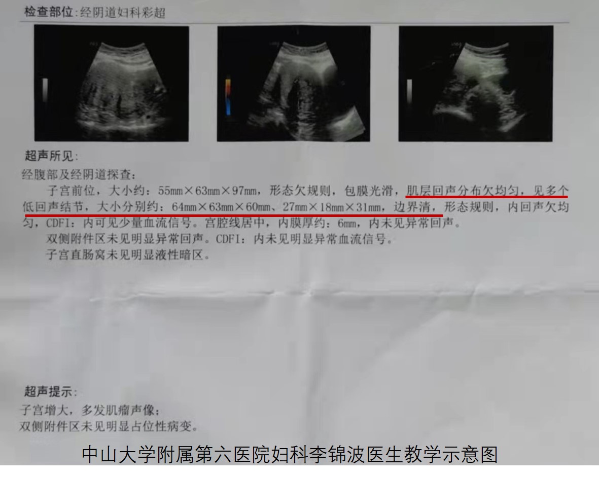 子宫肌瘤是不是必须做手术,子宫肌瘤做微创好还是手术开刀好