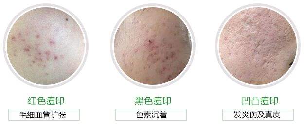 祛痘印最有效的方法洗面奶,祛痘印最有效的方法老爸评测