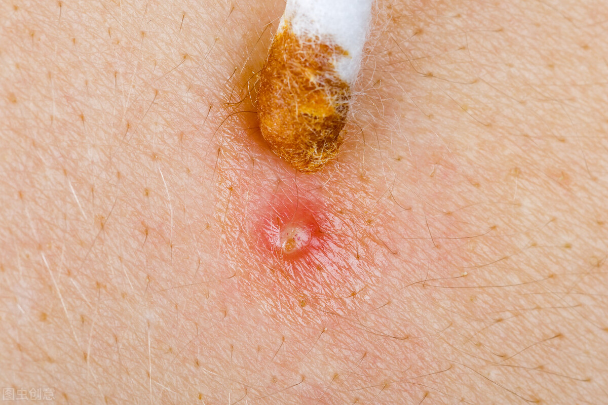 毛囊闭锁三联征跟血糖有关系吗,毛囊闭锁三联征可以用克拉霉素吗