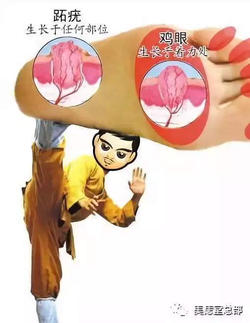 鸡眼和跖疣的区别有哪些,脚底鸡眼和跖疣的区别