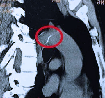 鱼刺卡喉咙没感觉了还用检查吗,小鱼刺卡喉咙吞咽没感觉