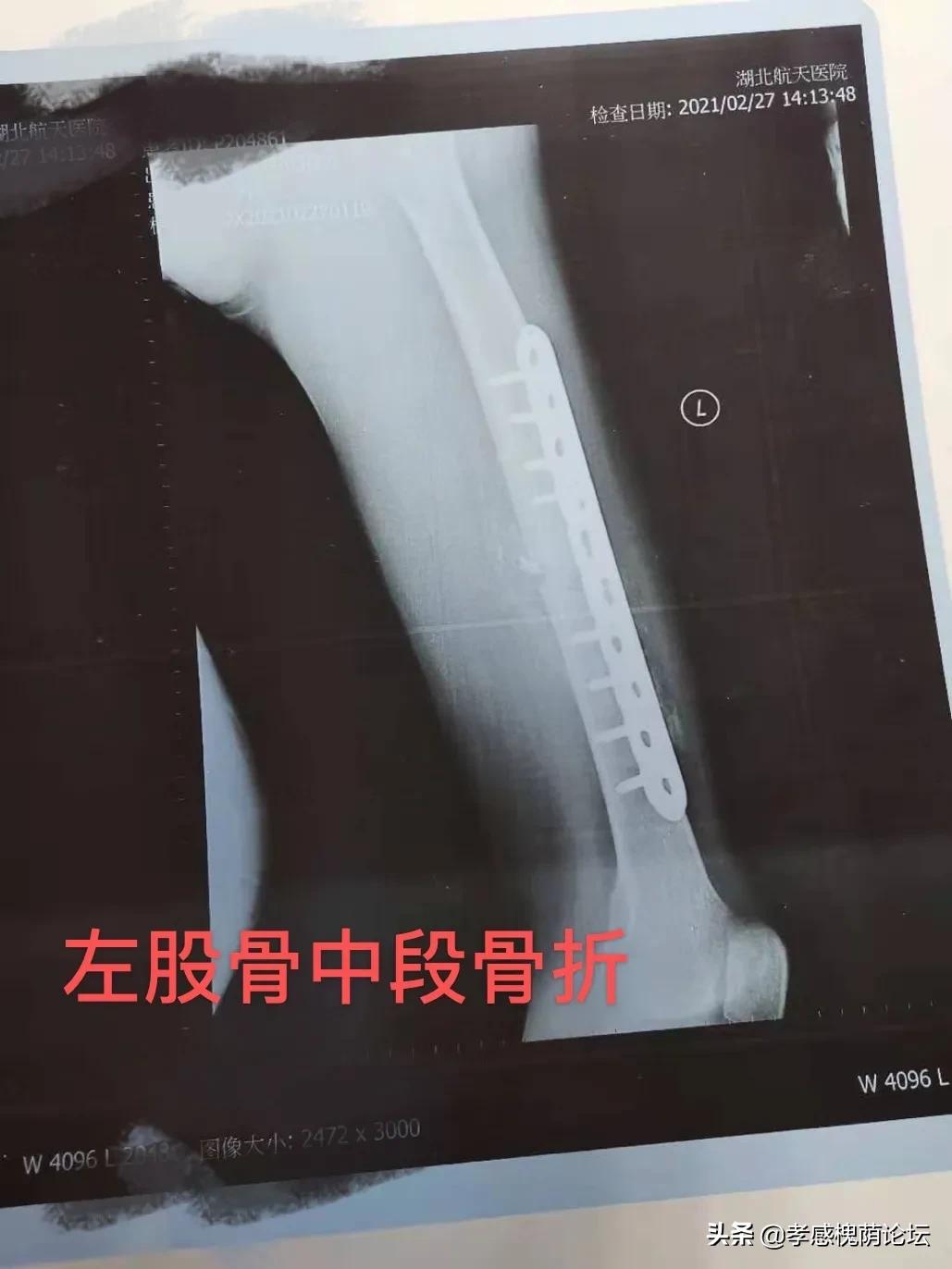 伤筋动骨一百天是对的吗,伤筋动骨一百天真的不能动吗