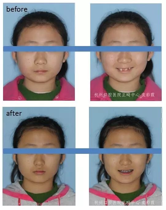 牙齿深覆合对脸型的影响,覆合型牙齿是怎么造成的