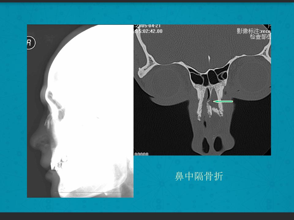 鼻骨骨折复位全过程,诊断证明鼻骨骨折问号是什么意思