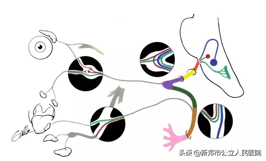 面瘫不是想得就得的,面瘫一点风都不能吹吗