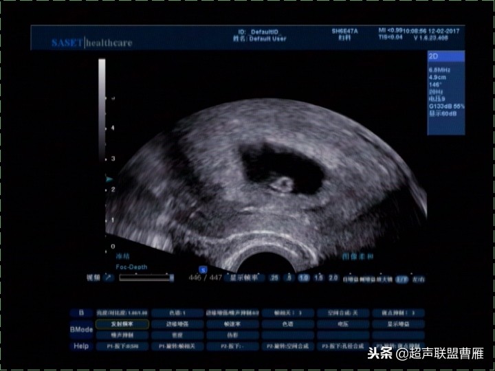 内见卵黄囊,卵黄囊肿瘤