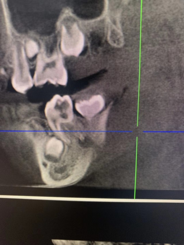 牙源性上颌窦炎牙龈瘘管,牙源性脓肿的症状