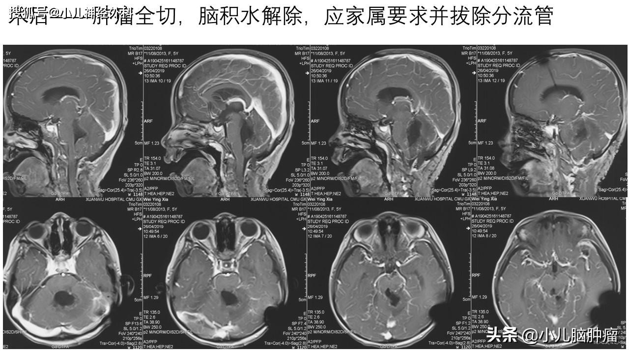颅内肿瘤引起脑积水，是不是都要做分流手术