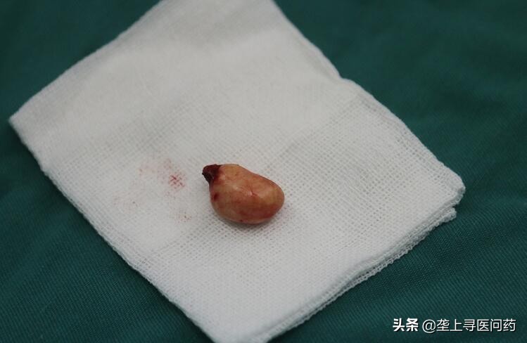 小孩眼睛长了良性肿瘤,孩子眼睛突然斜视会是大脑肿瘤吗