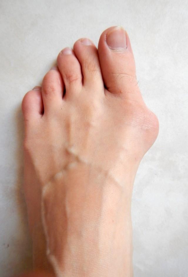 拇外翻大脚趾疼如何在家就能治,大脚拇指痛要警惕