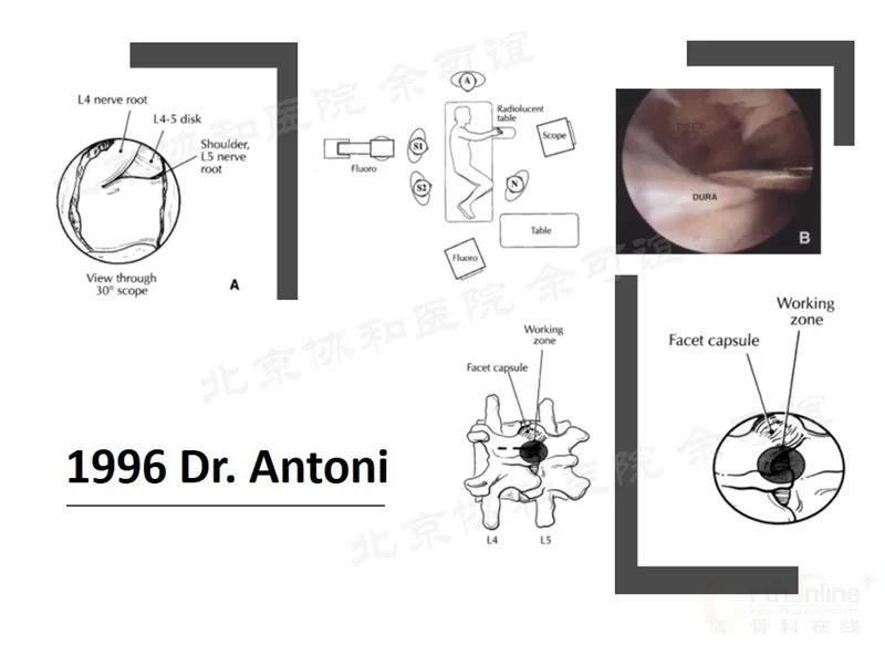 单侧双通道脊柱内镜技术优势,双通道脊柱内镜