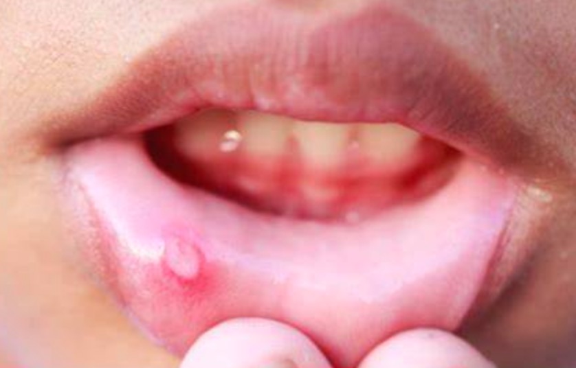 口腔溃疡引起牙齿痛,口腔溃疡引起面部疼痛