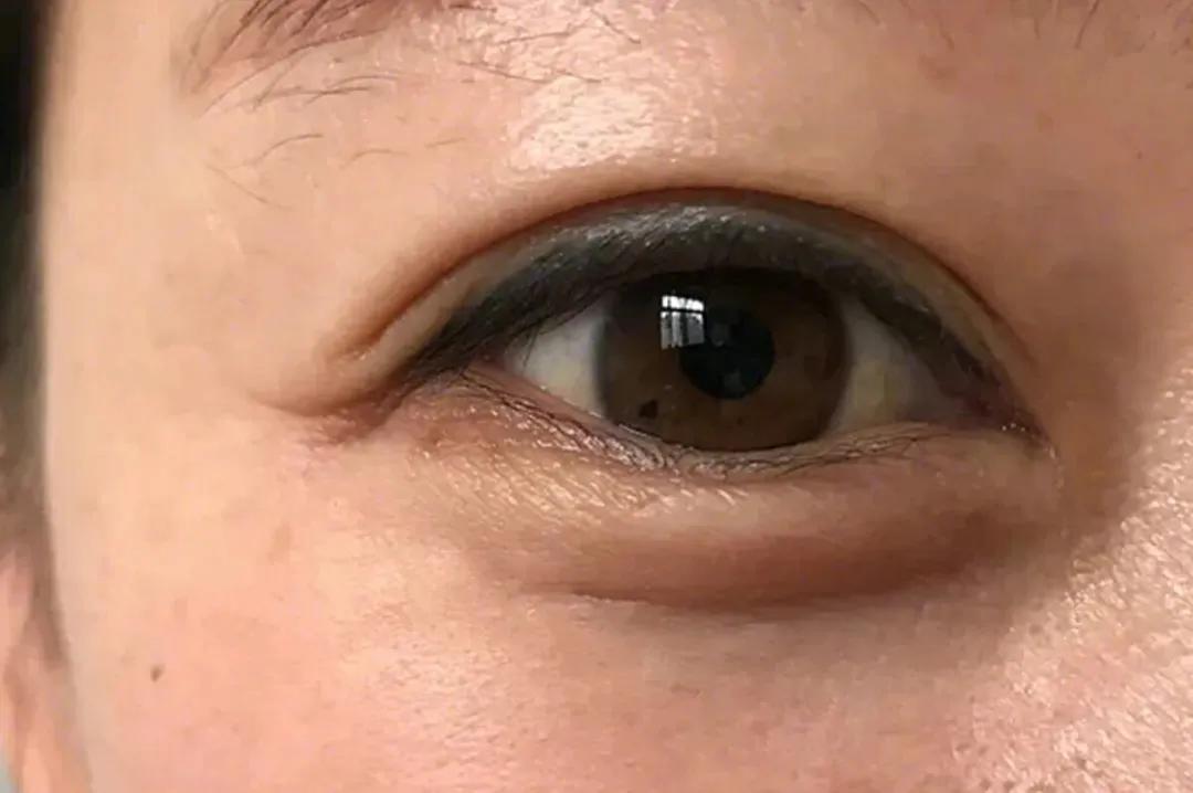 脸部除皱教学,脸部除皱哪种方法安全