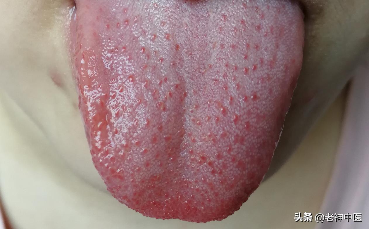 儿童外感引起口舌生疮,口舌生疮古方凉茶特效药