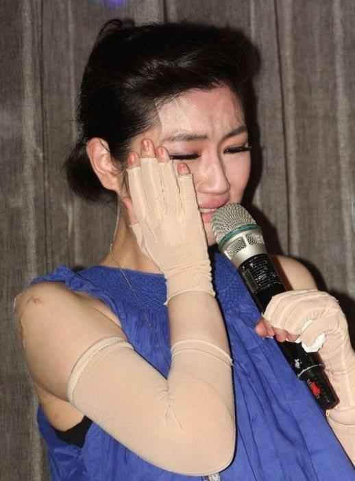 任家萱讲述烧伤经历,任家萱烧伤完整赔偿