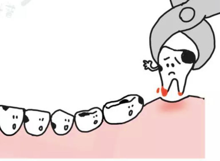 蛀牙治疗科普,蛀牙安全有效的方法