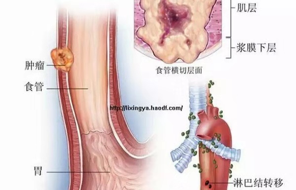 看似和癌症不相关的一些“小症状”,你注意过吗?