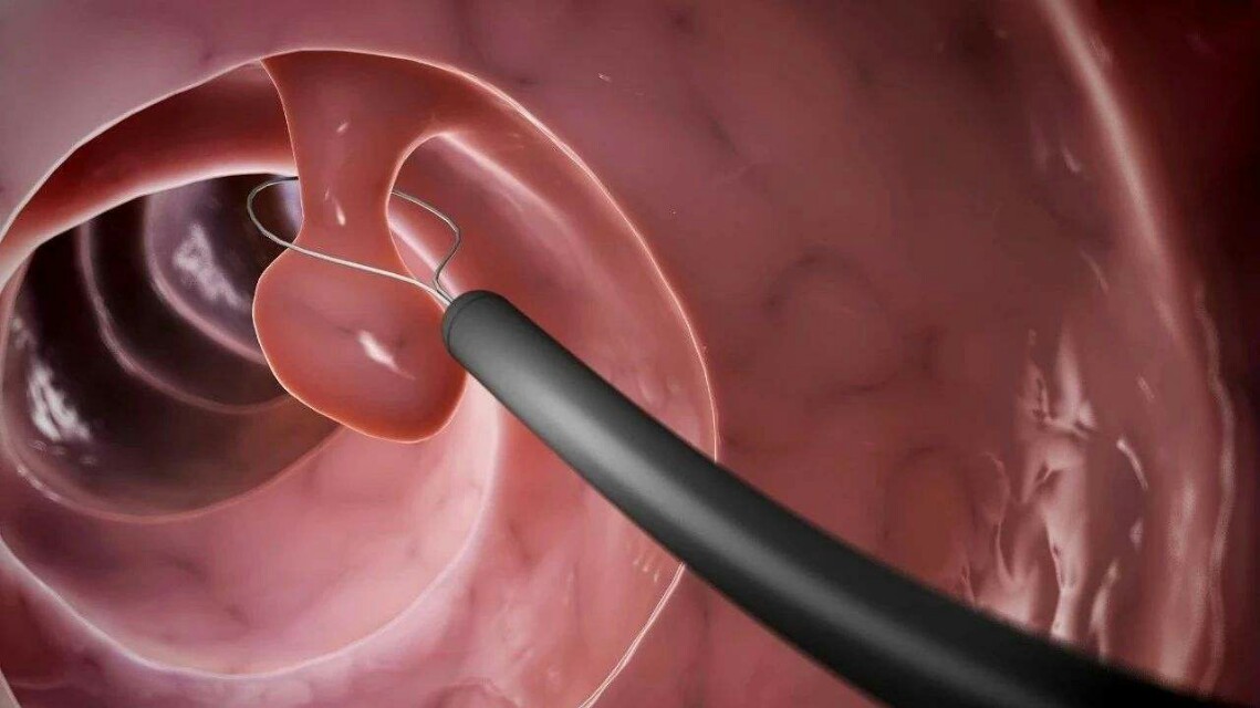 结肠息肉切除后怎么防止复发,结肠息肉发展到癌的过程