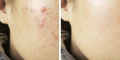 博乐达水杨酸祛闭口多久能有效,博乐达水杨酸面膜去闭口怎么样