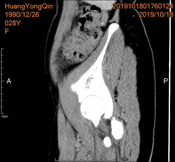 介入栓塞治疗巧克力囊肿,介入超声治巧克力囊肿需要多久
