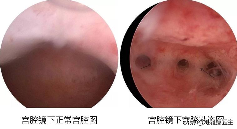 免疫治疗不良妊娠的方法,宫腔粘连合并妊娠