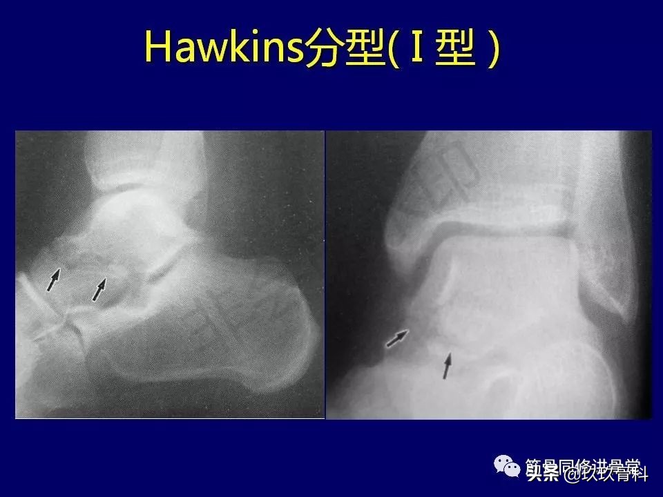距骨骨折的治疗原则,距骨骨折如何调理