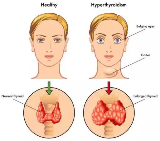 甲亢性眼突婴儿,8岁的小孩得了甲亢能自愈吗