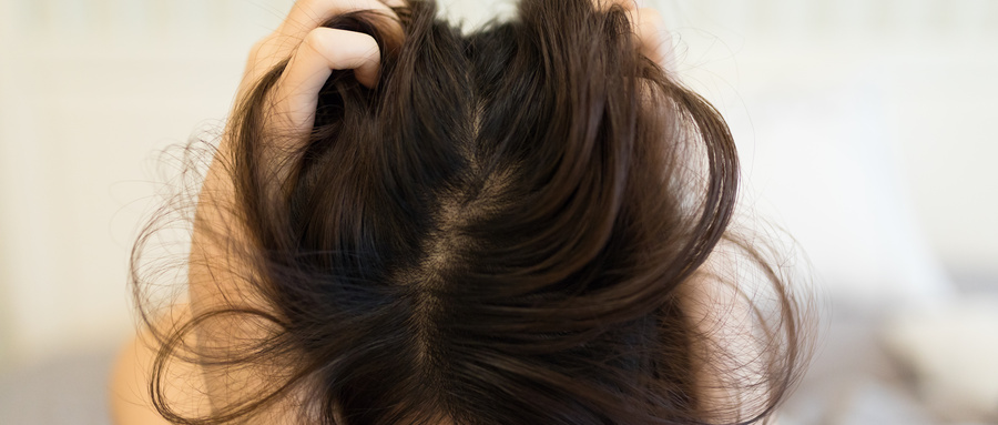 有头屑头皮痒怎么解决小妙招,去头屑头皮痒最有效的办法