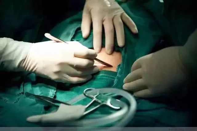 剖腹产必须知道的几件事,剖腹产的宝宝四大优点