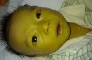 早产儿满月黄疸还没退怎么办,宝宝满月了黄疸还没退怎么办