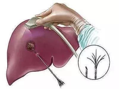 肝囊肿20-20mm要不要紧,脂肪肝肝囊肿胆囊息肉要不要紧