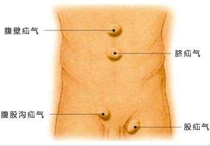 老年腹股沟疝气保守治疗有效方法,疝气中医治疗怎么锻炼有助于恢复