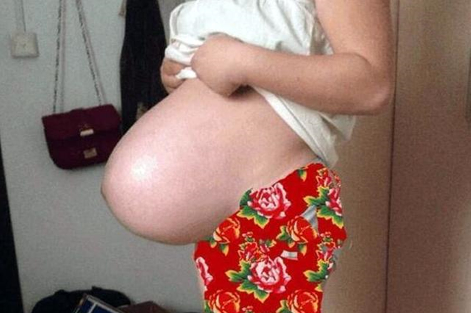 若你是“悬浮肚”，十有八九要剖腹产，想顺产需要先突破两大难题