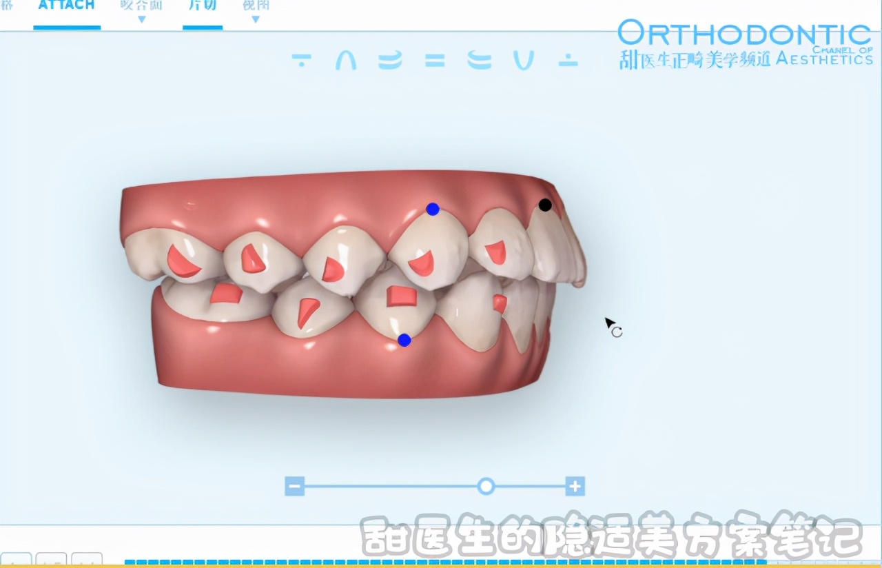 下颌后缩、咬合不对位，能用隐适美矫正吗？曹甜博士视频讲解案例